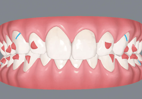 Clinical Studies on Invisalign: What You Need to Know