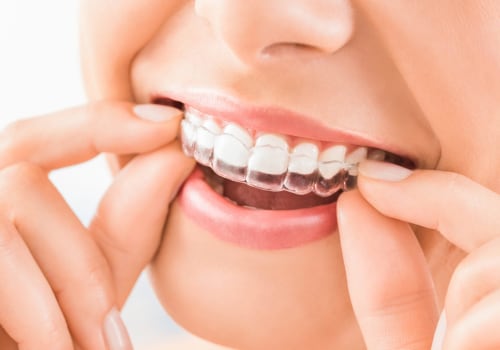 Tips for Wearing Your Aligners Comfortably