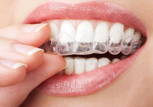 Risks Associated with Using Clear Aligners