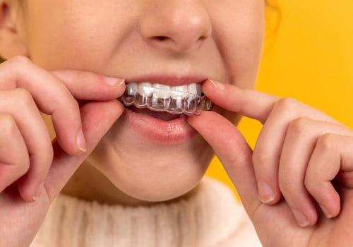 Advantages of Invisalign over Braces