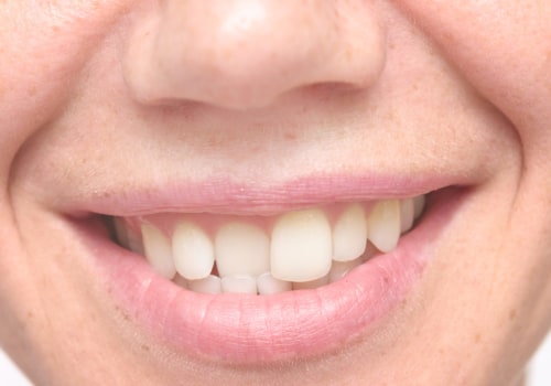 Non-Orthodontic Treatments for Crooked Teeth