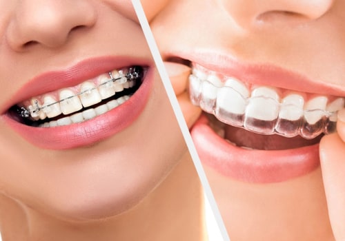 Clear braces vs. Invisalign for adults: Exploring the Best Option for You