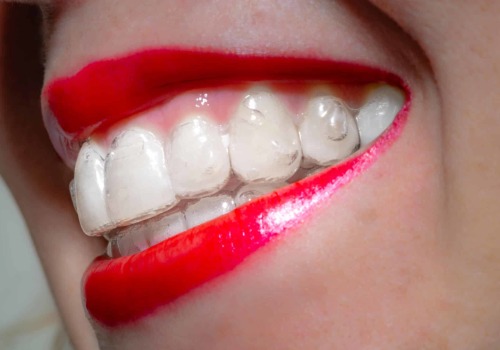 Uncovering Patient Stories and Experiences with Invisalign