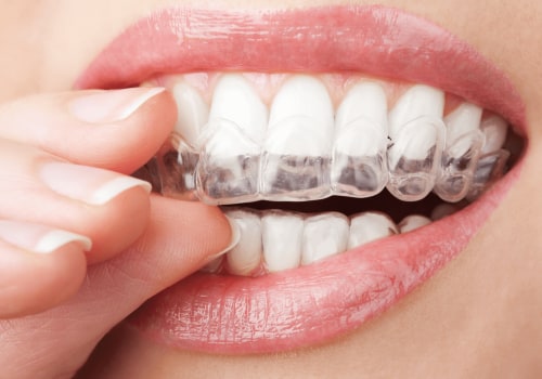 Reasons to Choose Invisalign Over Other Treatments