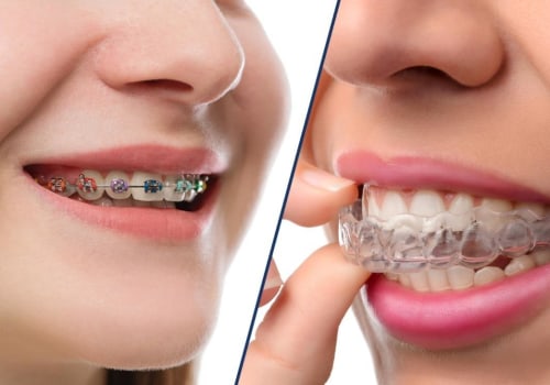 Benefits of Clear Aligners Over Metal Braces