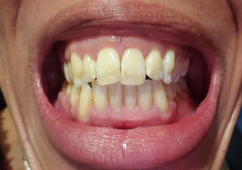 Online Ratings of Invisalign