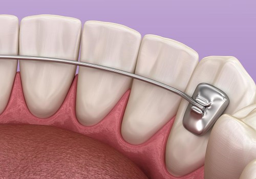 Retainers as an Alternative to Clear Aligners