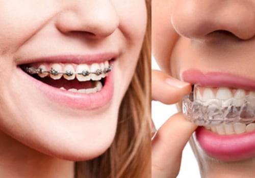 Pros and Cons of Traditional Braces vs Invisalign