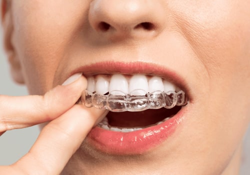 Invisalign Treatment Process: An Overview