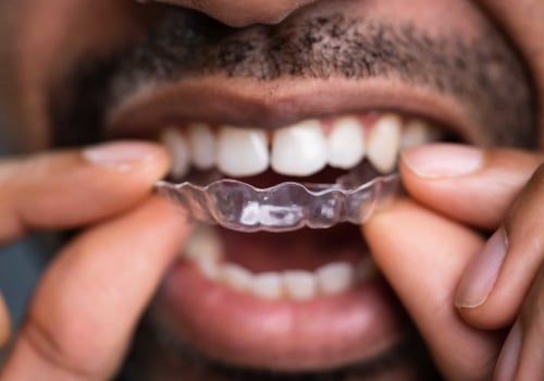 Oral Health Professionals' Advice on Invisalign