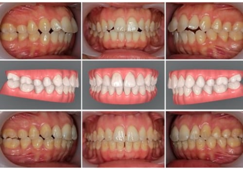 Research on the Effectiveness of Invisalign