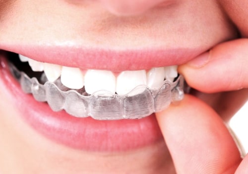 Alternative Treatments for Teeth Straightening