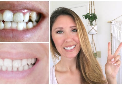 Before and After Photos of Invisalign Patients