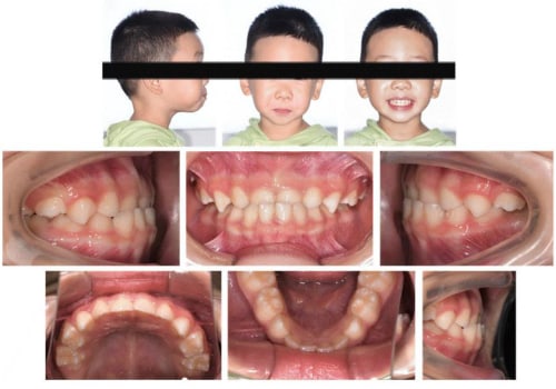 Successful Invisalign Treatments: Case Studies and Patient Photos